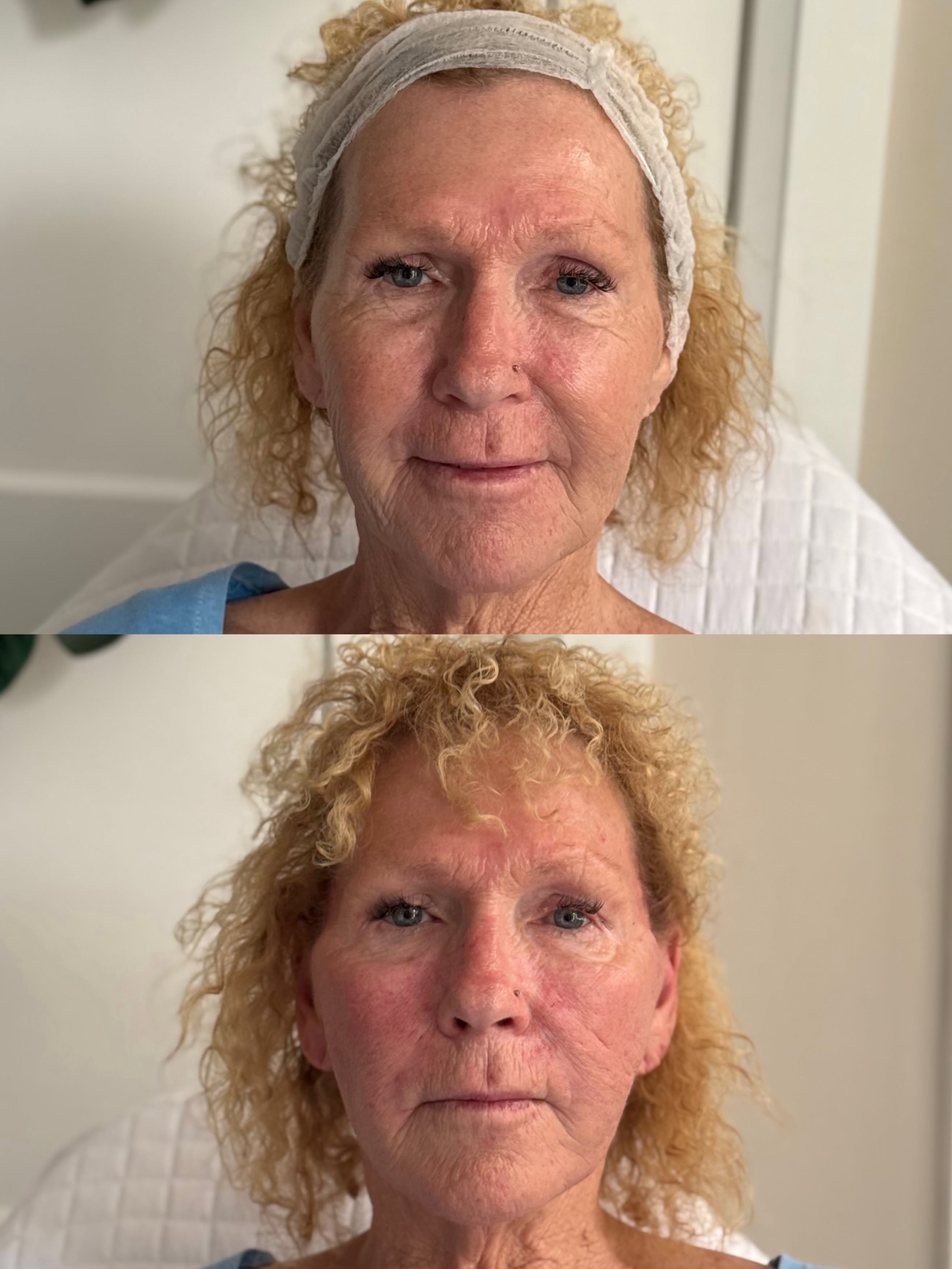 Skin Resurfacing Result